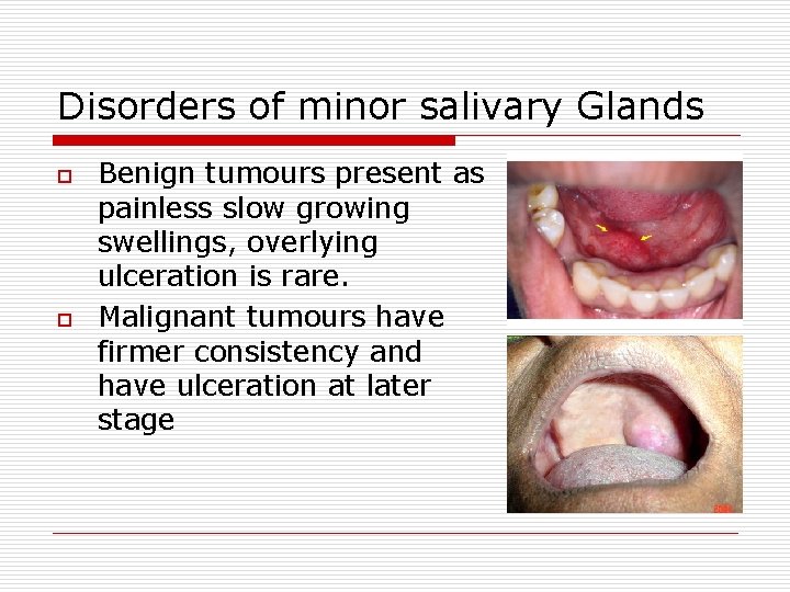 Disorders of minor salivary Glands o o Benign tumours present as painless slow growing