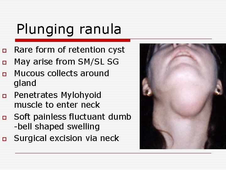 Plunging ranula o o o Rare form of retention cyst May arise from SM/SL