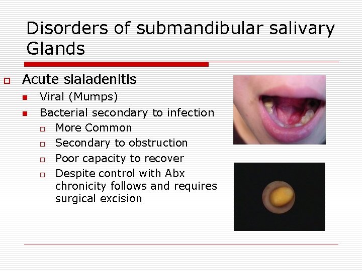 Disorders of submandibular salivary Glands o Acute sialadenitis n n Viral (Mumps) Bacterial secondary