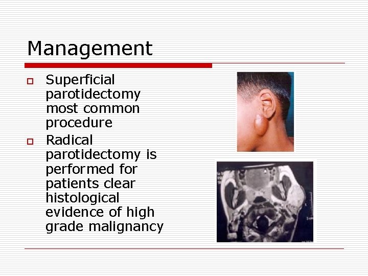 Management o o Superficial parotidectomy most common procedure Radical parotidectomy is performed for patients