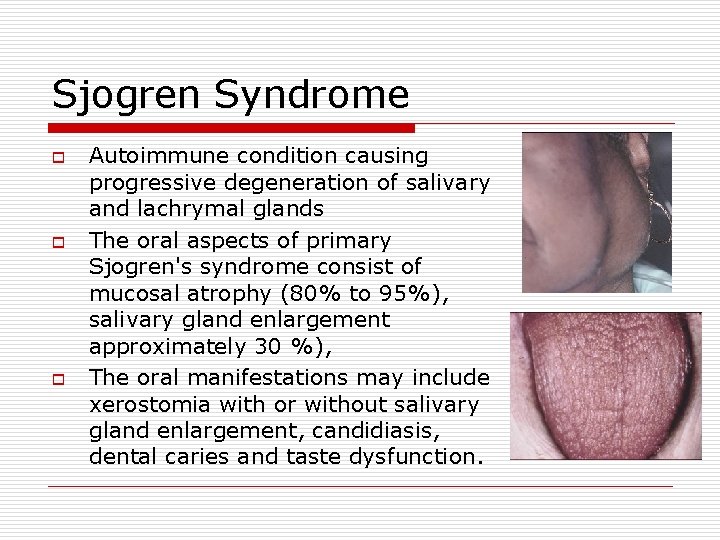 Sjogren Syndrome o o o Autoimmune condition causing progressive degeneration of salivary and lachrymal