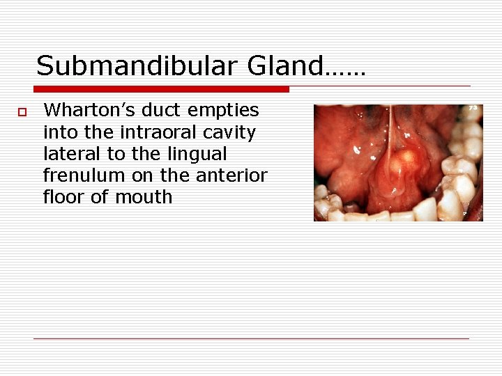 Submandibular Gland…… o Wharton’s duct empties into the intraoral cavity lateral to the lingual