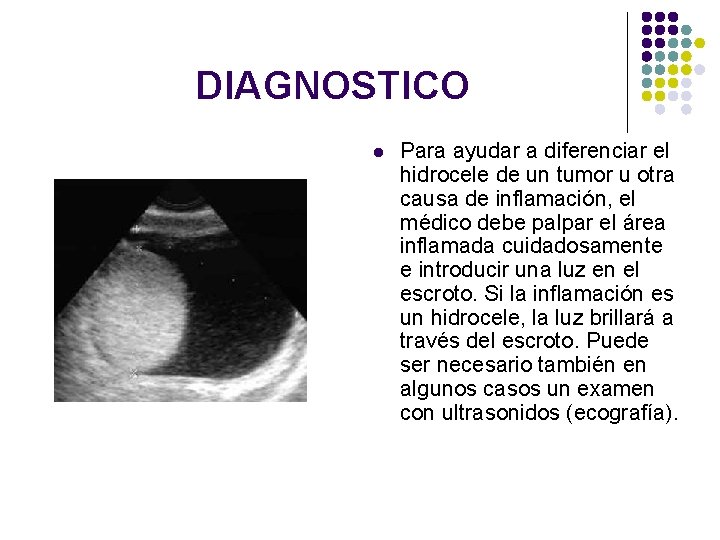 DIAGNOSTICO l Para ayudar a diferenciar el hidrocele de un tumor u otra causa