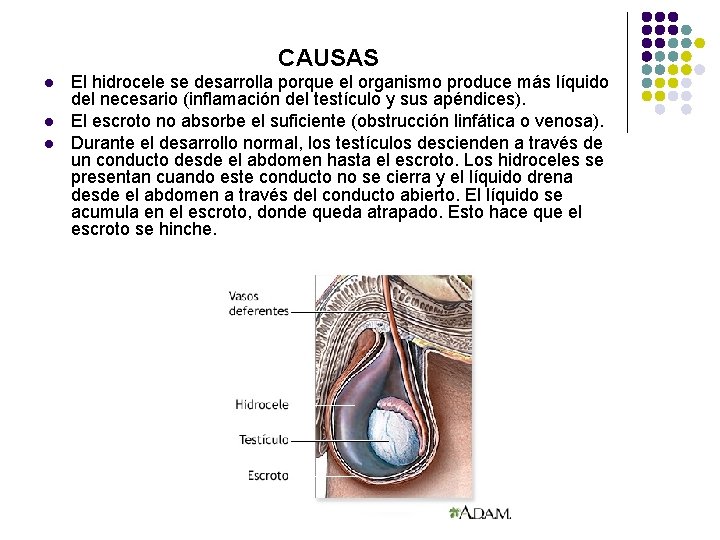 CAUSAS l l l El hidrocele se desarrolla porque el organismo produce más líquido