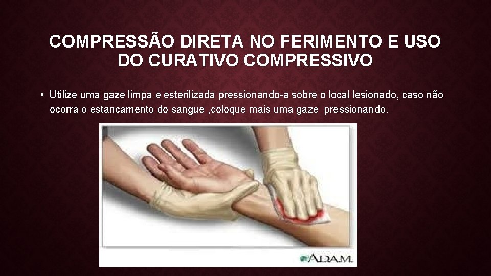 COMPRESSÃO DIRETA NO FERIMENTO E USO DO CURATIVO COMPRESSIVO • Utilize uma gaze limpa