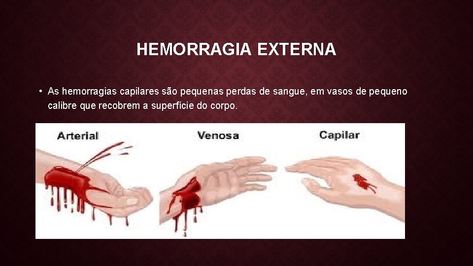 HEMORRAGIA EXTERNA • As hemorragias capilares são pequenas perdas de sangue, em vasos de