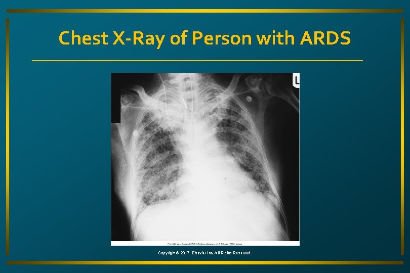 Chest X-Ray of Person with ARDS Copyright © 2017, Elsevier Inc. All Rights Reserved.