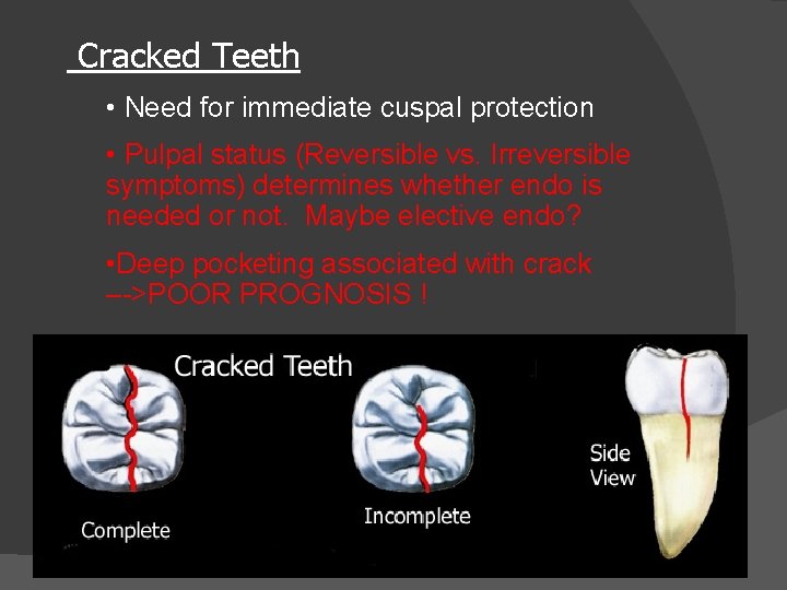 Cracked Teeth • Need for immediate cuspal protection • Pulpal status (Reversible vs. Irreversible