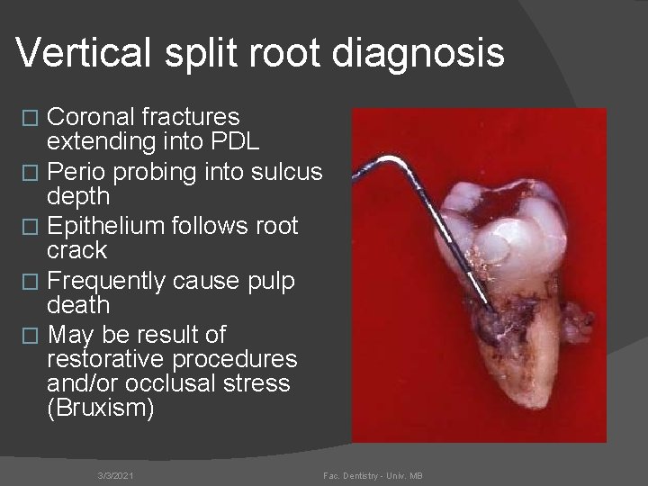 Vertical split root diagnosis Coronal fractures extending into PDL � Perio probing into sulcus