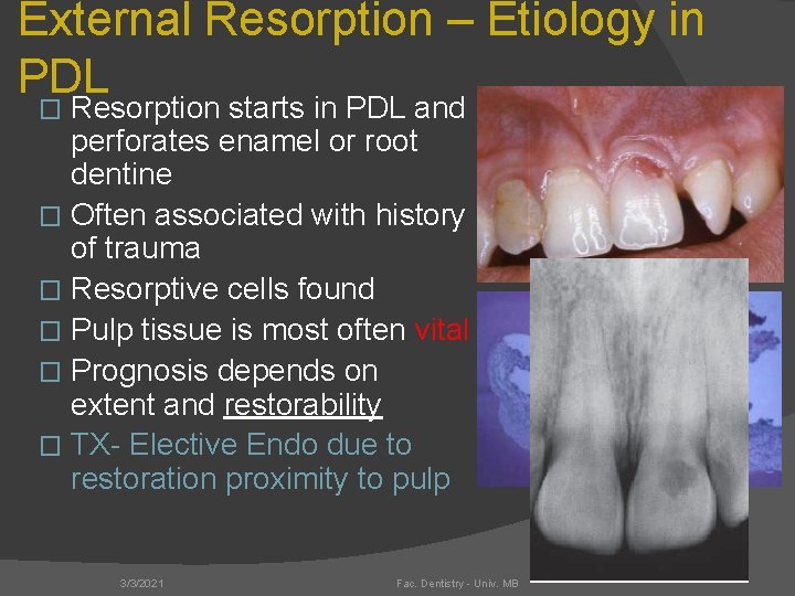 External Resorption – Etiology in PDL Resorption starts in PDL and perforates enamel or