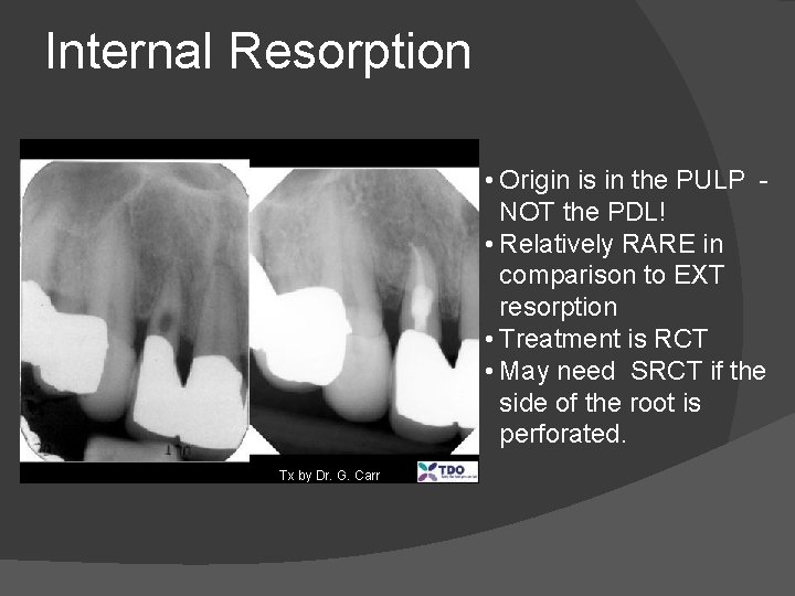 Internal Resorption • Origin is in the PULP NOT the PDL! • Relatively RARE