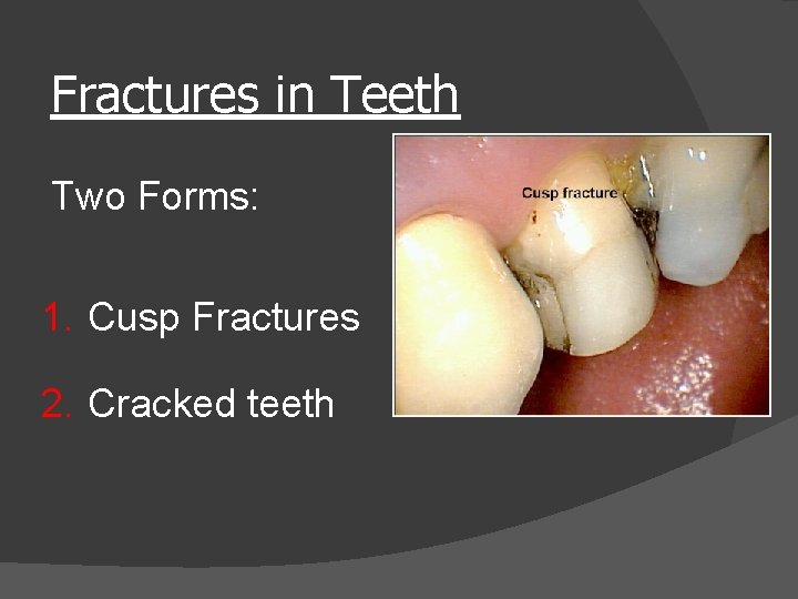 Fractures in Teeth Two Forms: 1. Cusp Fractures 2. Cracked teeth 