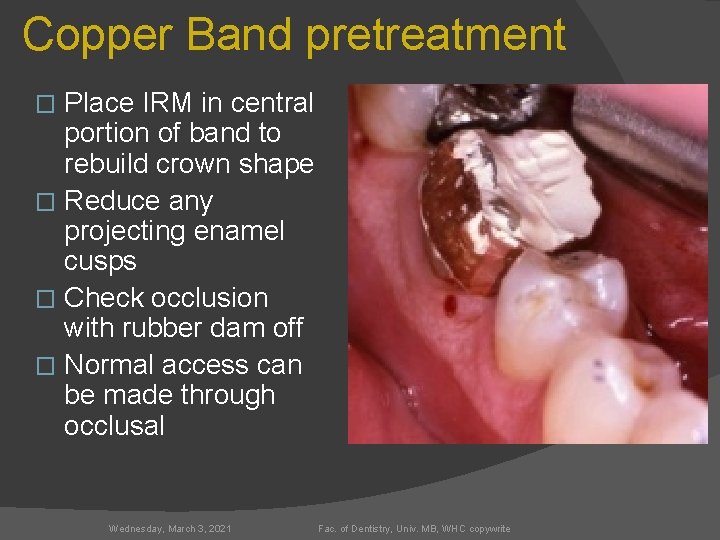 Copper Band pretreatment Place IRM in central portion of band to rebuild crown shape