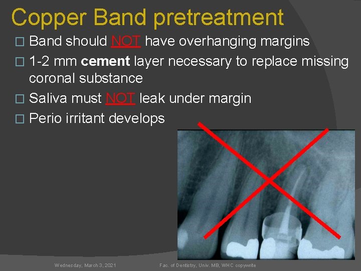 Copper Band pretreatment Band should NOT have overhanging margins � 1 -2 mm cement