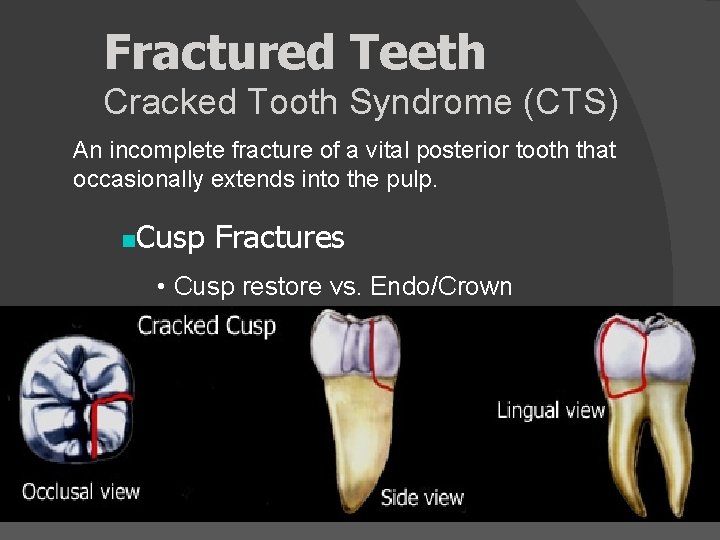 Fractured Teeth Cracked Tooth Syndrome (CTS) An incomplete fracture of a vital posterior tooth