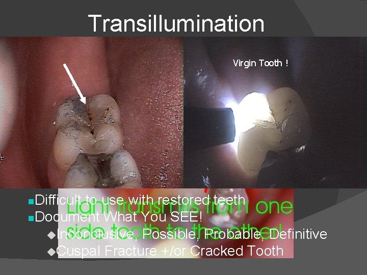 Transillumination � Helps identify crown fracture Virgin Tooth ! � Fractured Segments of a