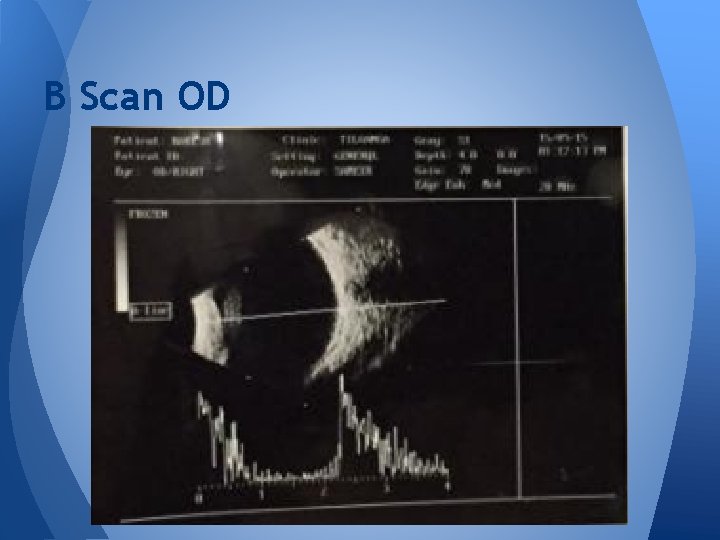 B Scan OD B Scan OD
