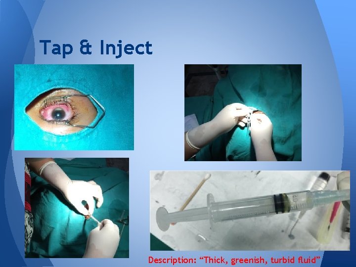 Tap & Inject Description: “Thick, greenish, turbid fluid” Tap & Inject Description: “Thick, greenish, turbid fluid”