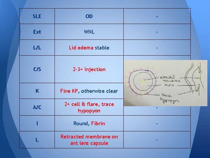SLE OD - Ext WNL - L/L Lid edema stable - C/S 2 -3+ SLE OD - Ext WNL - L/L Lid edema stable - C/S 2 -3+