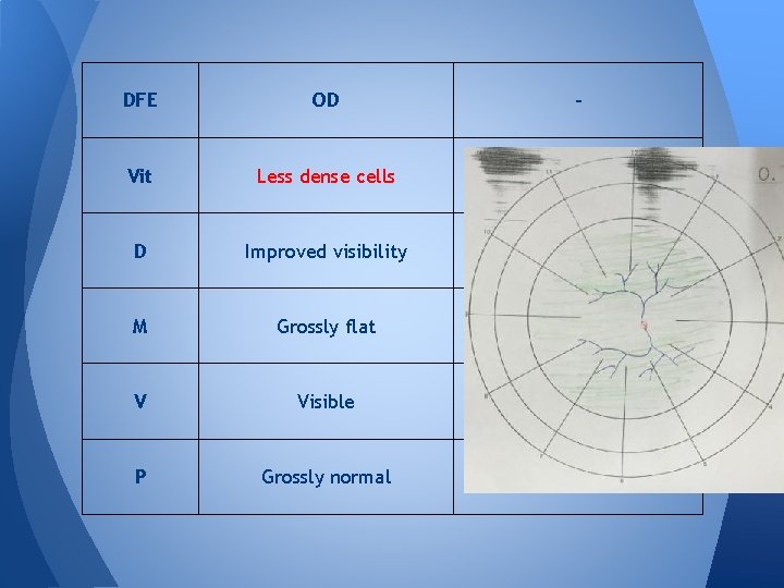 DFE OD - Vit Less dense cells - D Improved visibility - M Grossly DFE OD - Vit Less dense cells - D Improved visibility - M Grossly