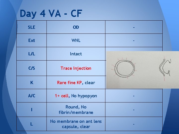Day 4 VA - CF SLE OD - Ext WNL - L/L Intact - Day 4 VA - CF SLE OD - Ext WNL - L/L Intact -