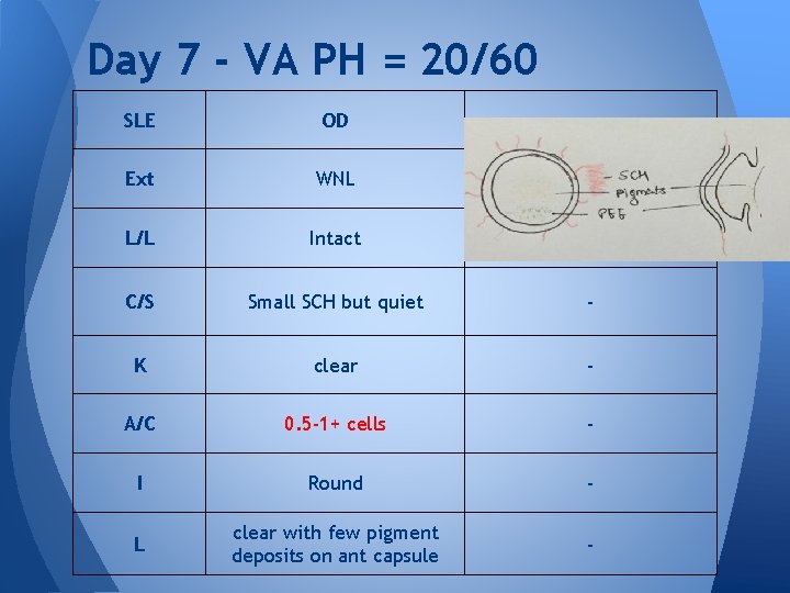 Day 7 - VA PH = 20/60 SLE OD - Ext WNL - L/L Day 7 - VA PH = 20/60 SLE OD - Ext WNL - L/L