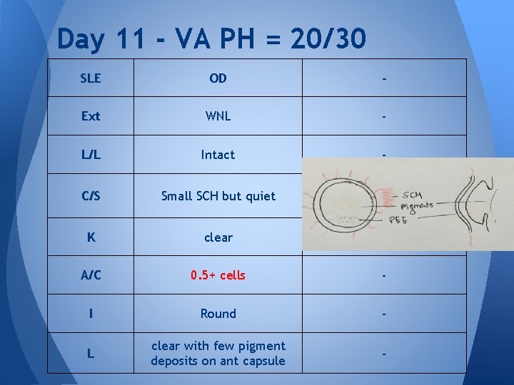 Day 11 - VA PH = 20/30 SLE OD - Ext WNL - L/L Day 11 - VA PH = 20/30 SLE OD - Ext WNL - L/L