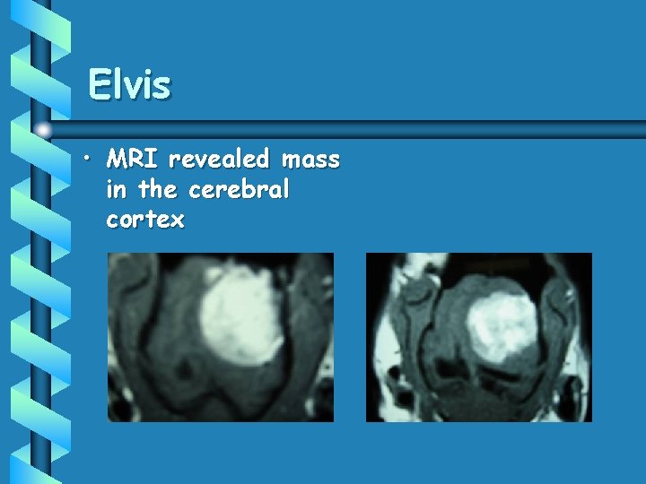 Elvis • MRI revealed mass in the cerebral cortex 