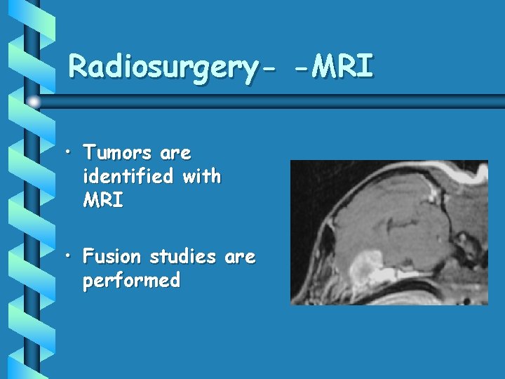 Radiosurgery- -MRI • Tumors are identified with MRI • Fusion studies are performed 