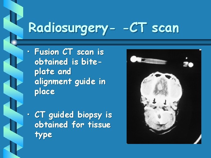 Radiosurgery- -CT scan • Fusion CT scan is obtained is biteplate and alignment guide