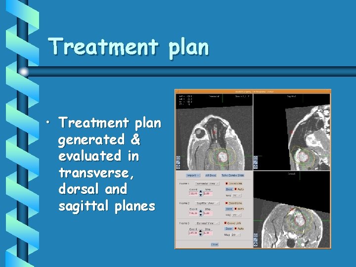 Treatment plan • Treatment plan generated & evaluated in transverse, dorsal and sagittal planes