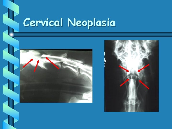 Cervical Neoplasia 