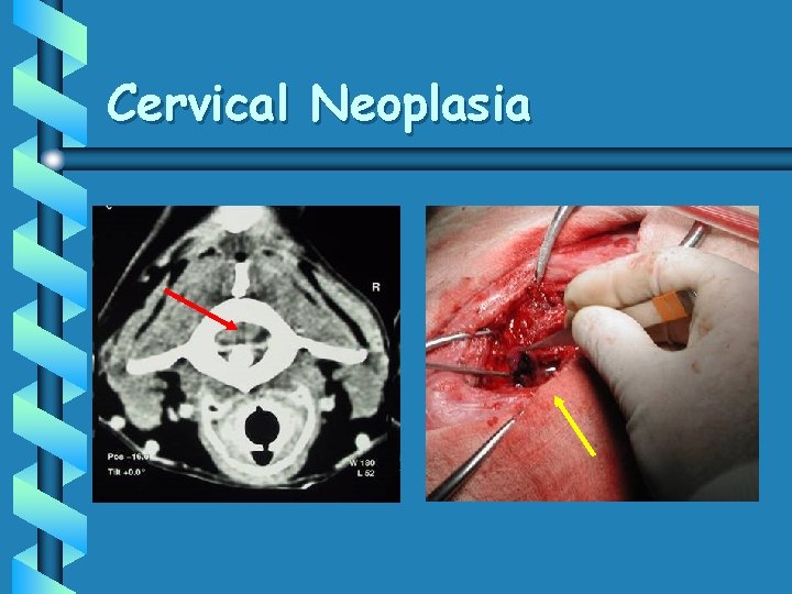 Cervical Neoplasia 