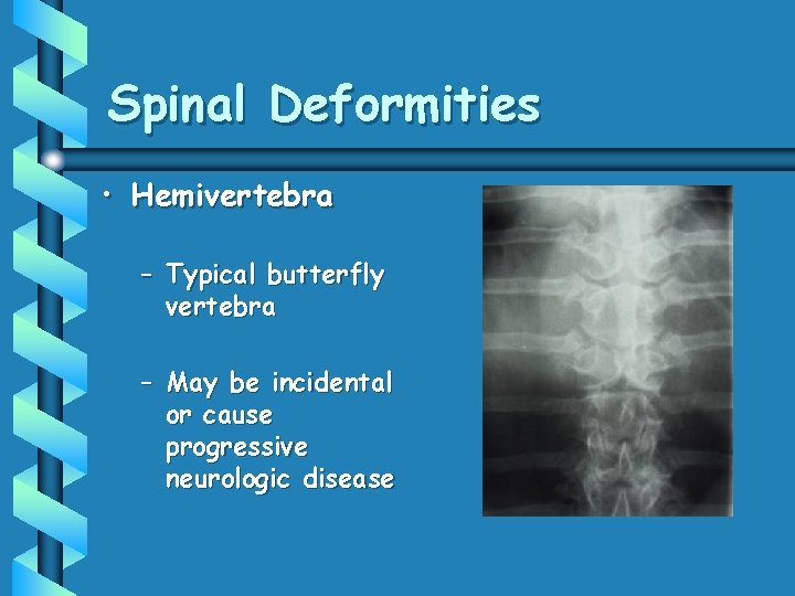 Spinal Deformities • Hemivertebra – Typical butterfly vertebra – May be incidental or cause