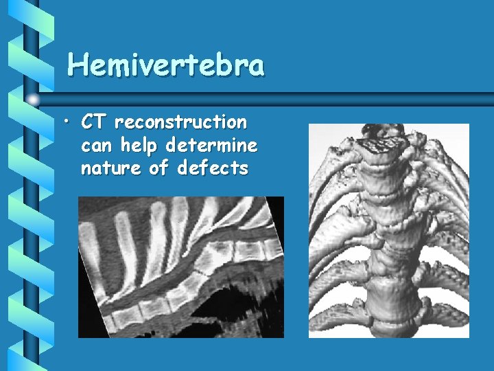 Hemivertebra • CT reconstruction can help determine nature of defects 