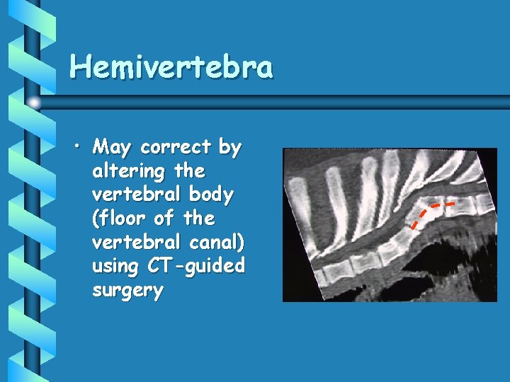 Hemivertebra • May correct by altering the vertebral body (floor of the vertebral canal)