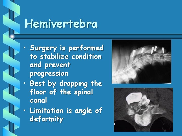 Hemivertebra • Surgery is performed to stabilize condition and prevent progression • Best by