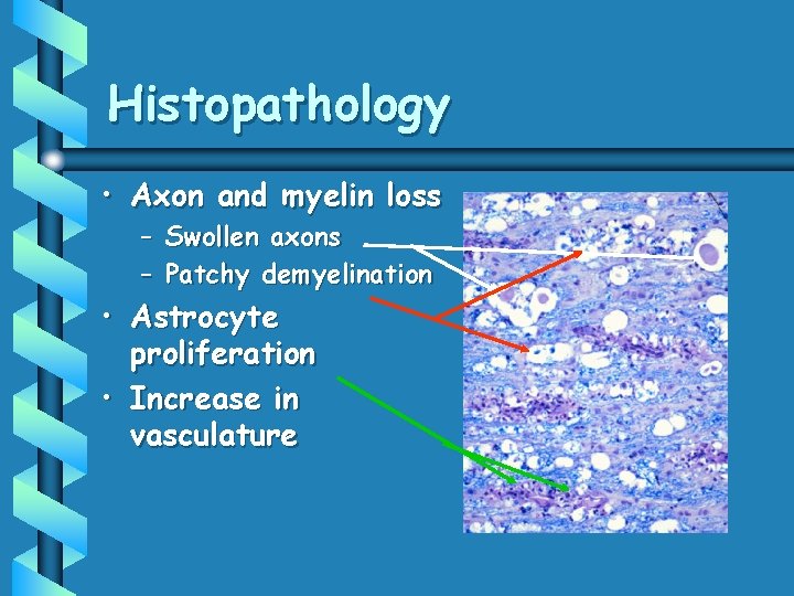 Histopathology • Axon and myelin loss – Swollen axons – Patchy demyelination • Astrocyte