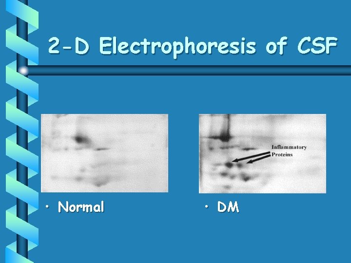 2 -D Electrophoresis of CSF • Normal • DM 