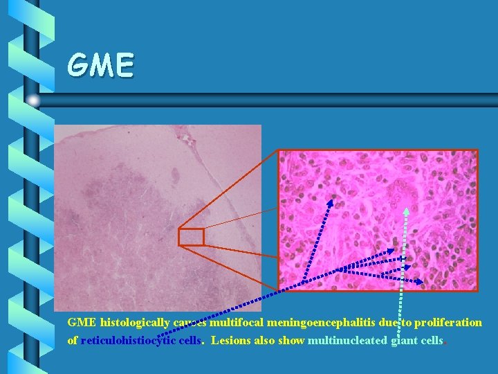 GME histologically causes multifocal meningoencephalitis due to proliferation of reticulohistiocytic cells. Lesions also show