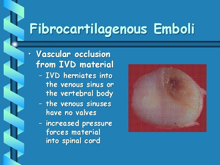 Fibrocartilagenous Emboli • Vascular occlusion from IVD material – IVD herniates into the venous