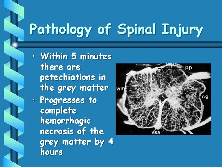 Pathology of Spinal Injury • Within 5 minutes there are petechiations in the grey