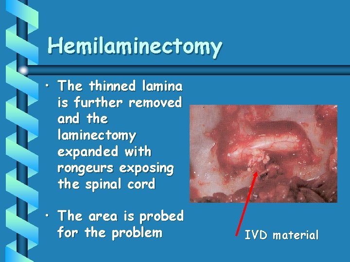 Hemilaminectomy • The thinned lamina is further removed and the laminectomy expanded with rongeurs