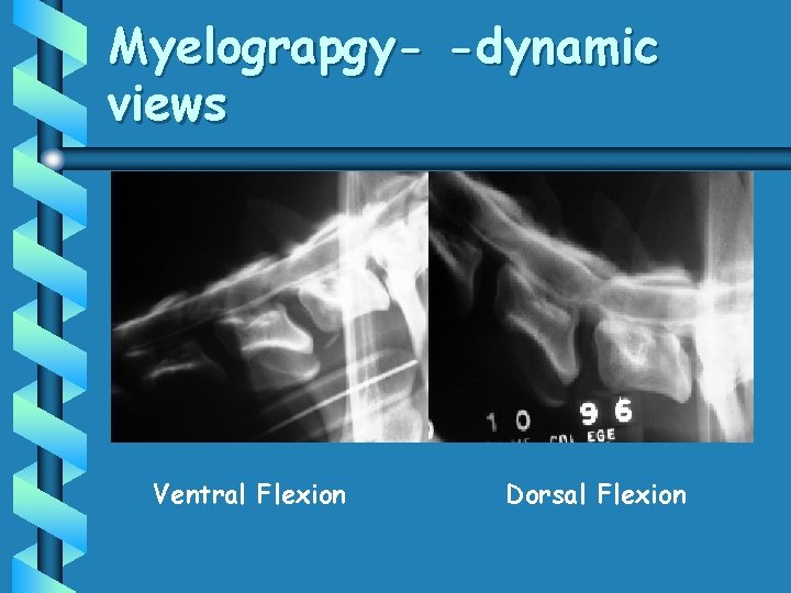 Myelograpgy- -dynamic views Ventral Flexion Dorsal Flexion 