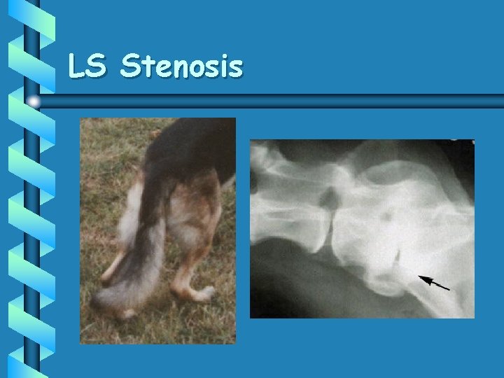 LS Stenosis 