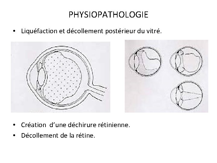 PHYSIOPATHOLOGIE • Liquéfaction et décollement postérieur du vitré. • Création d’une déchirure rétinienne. •