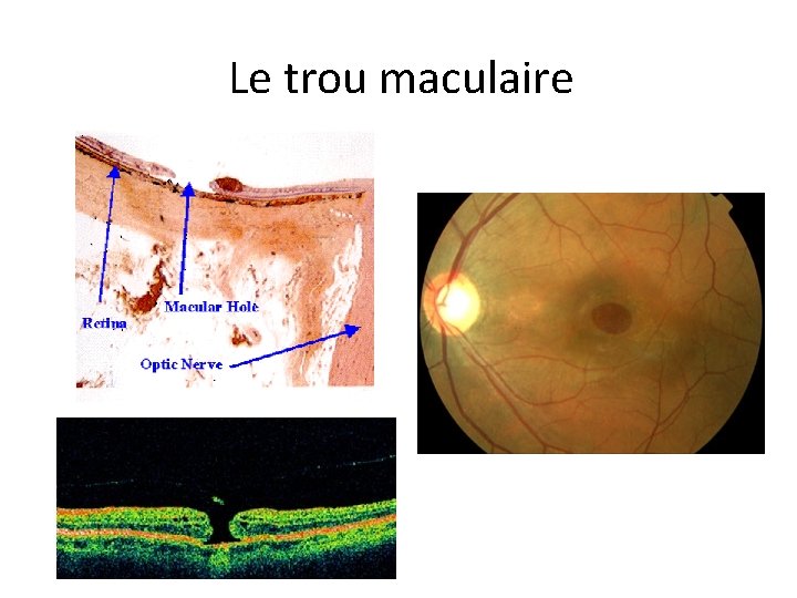 Le trou maculaire 