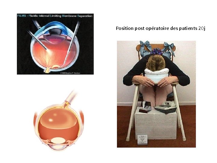 Position post opératoire des patients 20 j 