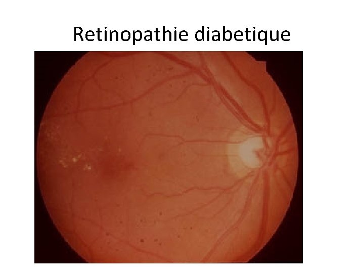 Retinopathie diabetique 