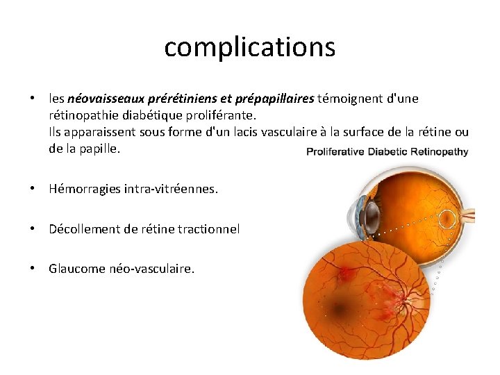 complications • les néovaisseaux prérétiniens et prépapillaires témoignent d'une rétinopathie diabétique proliférante. Ils apparaissent